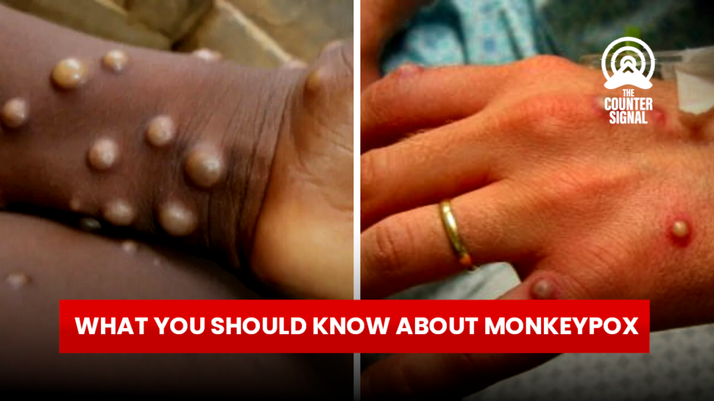 What you should know about monkeypox